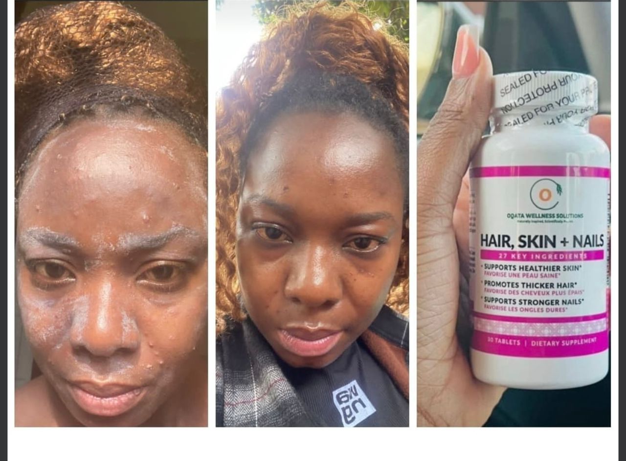 To Make Your Hair Grow, Do Away With Skin Rashes for Smooth Skin, Make Your Nails Grow,Here is the Solution