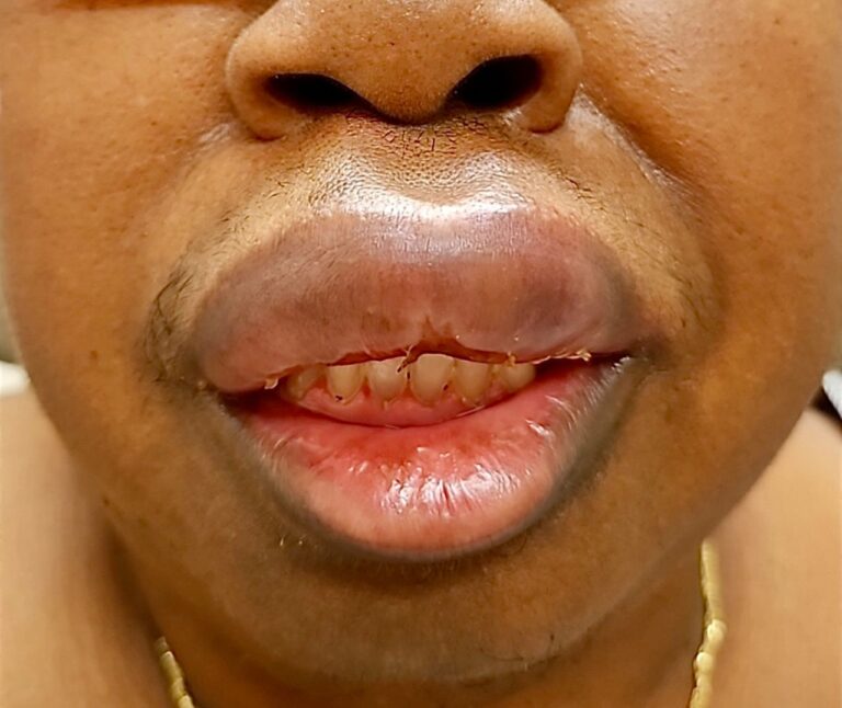 Man’s Tongue Swells to the Size of a Mango After Lying in Court